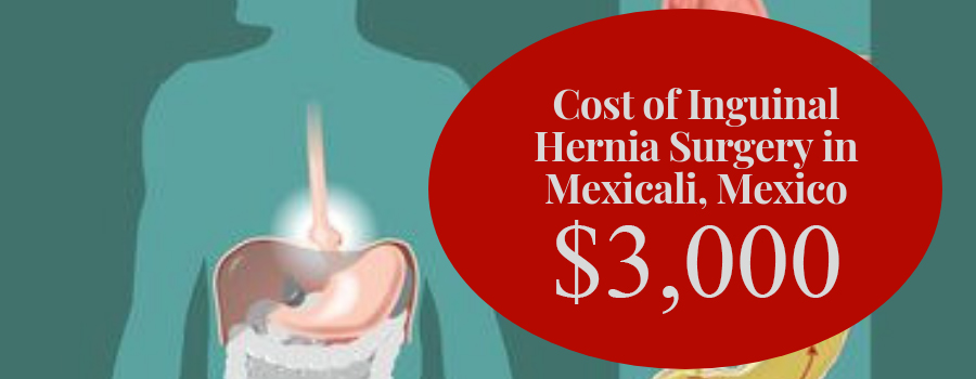 Inguinal Hernia Surgery Cost in Mexicali, Mexico